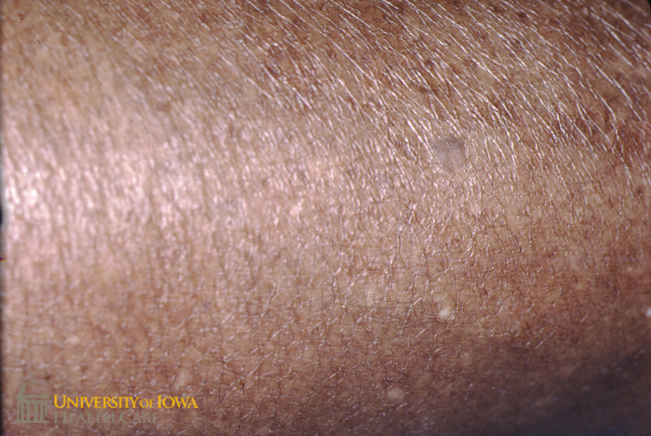 Numerous hypopigmented macules on the extremity. (click images for higher resolution).